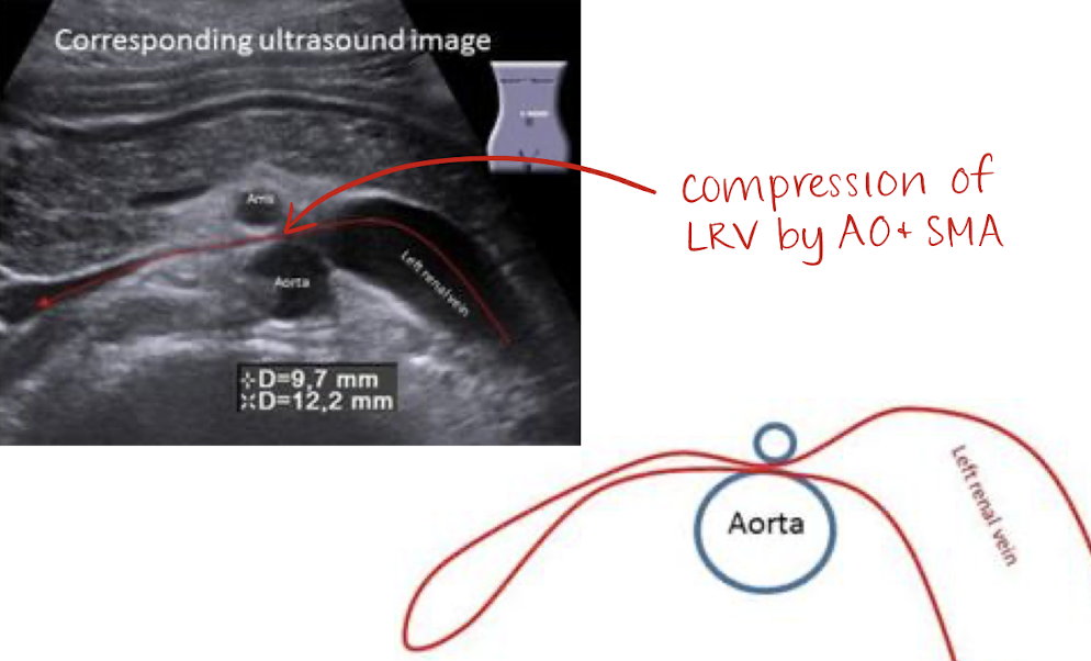 <p><u>compression or LRV</u> by AO and SMA</p>