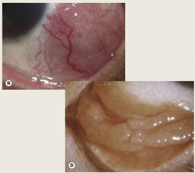 <p>Radiotherapy, chemotherapy, surgical excision, and cryotherapy.</p>
