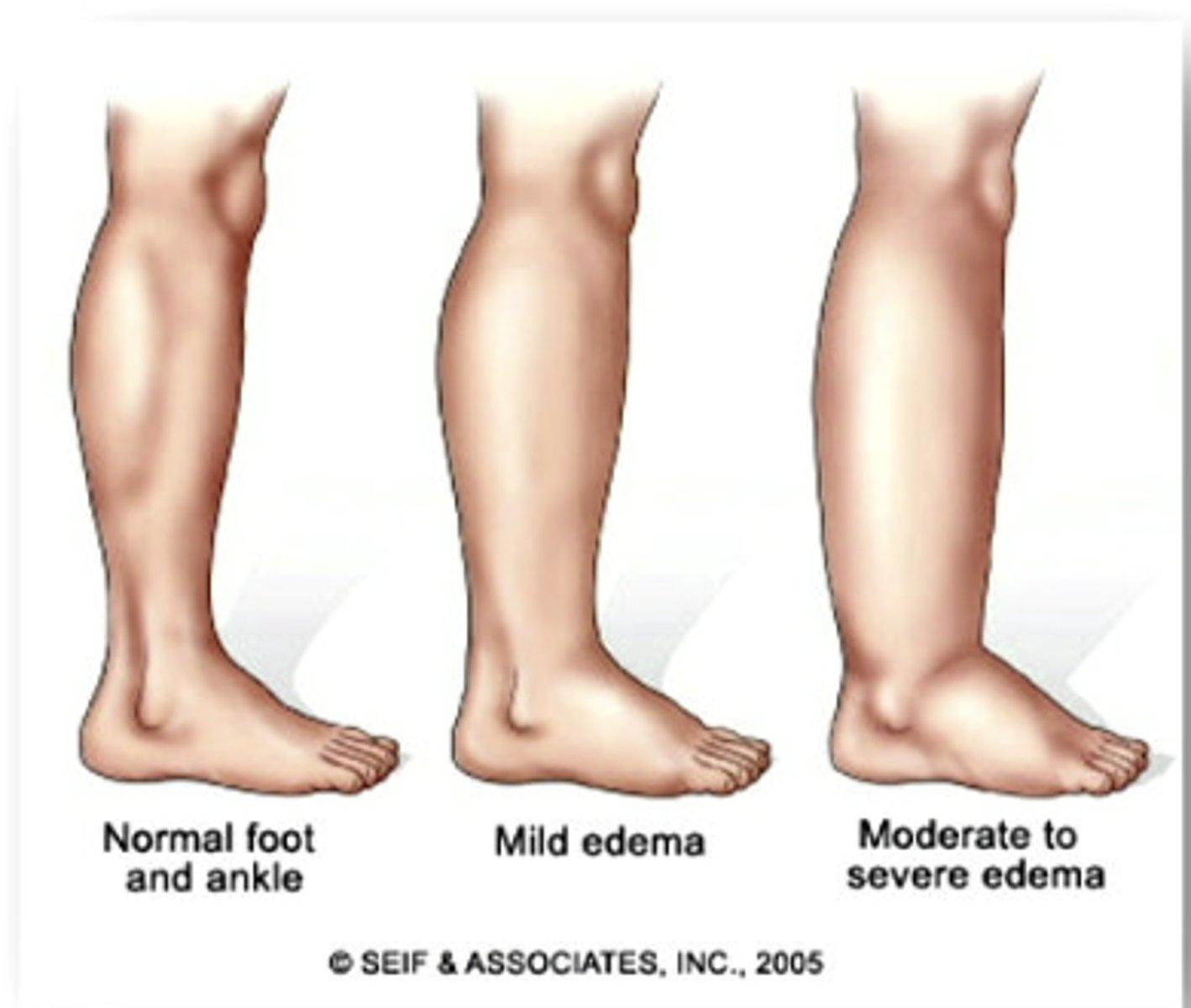 <p>what causes edema?</p>