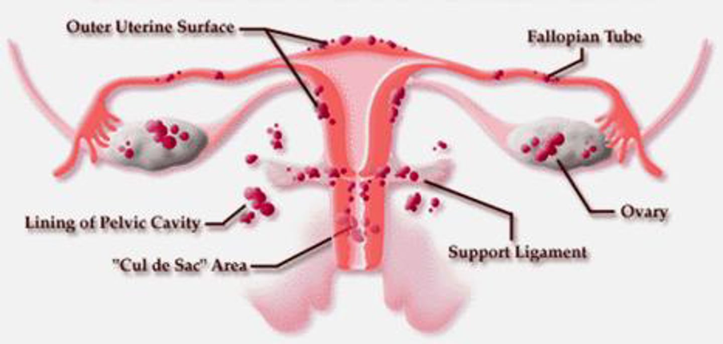 <p>Development of endometrial tissue normally lining the uterus in extrauterine locations in abdomen and pelvis, most commonly the uterosacral ligaments. Each menstrual cycle the tissue bleeds, causing scarring and adhesions.</p><p>Sxs: Mod to severe abdominal, pelvic, or LBP before/during menstruation, irregular cycles, PM spotting, dyspareunia, pain during defecation, infertility</p><p>Tx: Manual therapy to break up scar tissue/adhesions, mobility to sustain elongation of tissues, surgery to remove endometrial tissue or total hysterectomy</p>