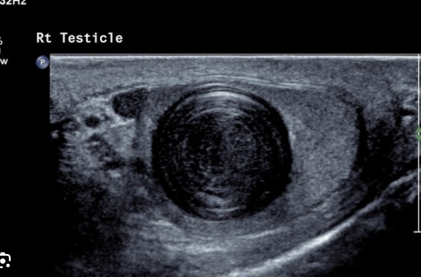 <p>Onion” or whorled appearance.**</p>