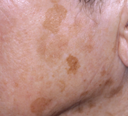 <p><span>benign brown patches associated with sun exposure</span></p>