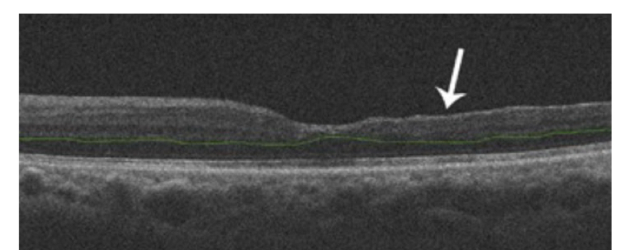 <p>disorganization and thinning of inner retina</p>