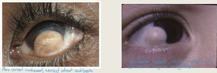 <p>Surgical-simple excision for small lesions to corneal transplants for lesions with extensive corneal involvement </p>