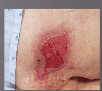<p>Pressure Injury Stage 2 </p>