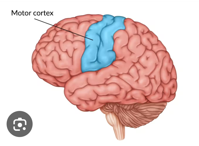 <p>Verlamming aan een helft van het lichaam.</p><p>Vernietiging van de motorische cortex aan de andere kant van de hersenen.</p>