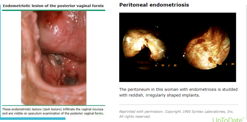<p><strong>Endometriosis: Diagnosis</strong></p><p>-Imaging → TVUS, laparoscopy with _______ is the definitive diagnosis</p><p>-Definitive diagnosis requires __________ confirmation of tissue biopsy typically obtained during laparoscopy </p><ul><li><p>During laparoscopy, areas of peritoneal endometriosis appear as _______ flame-like patches, whitish opacifications, yellow-brown ___________, translucent blebs, or reddish or reddish-blue irregularly-shaped islands </p></li><li><p>The appearance of some blue-brown lesions have been described as “_______ burns” </p></li></ul><p>-Presumptive _______ diagnosis based on symptoms, signs, and imaging findings </p><p></p>