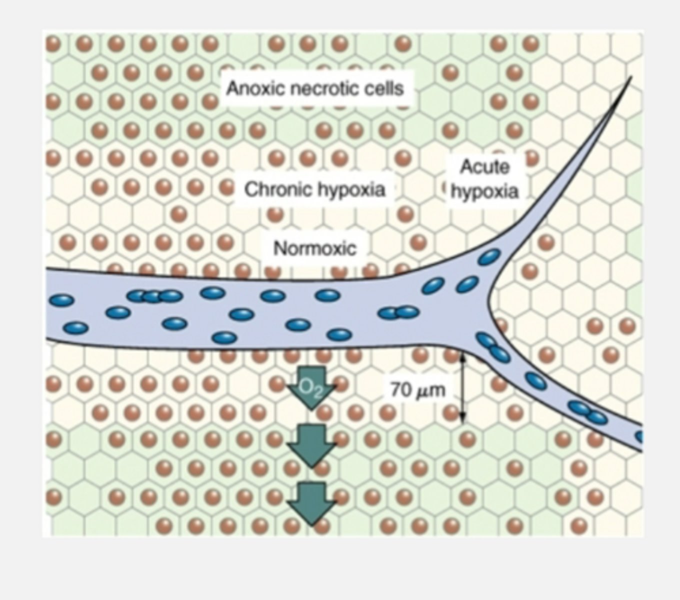 <p>Tumors can become acutely hypoxic due to blockage of a blood vessel</p><p>TRANSIENT OR INTERMITTENT</p>