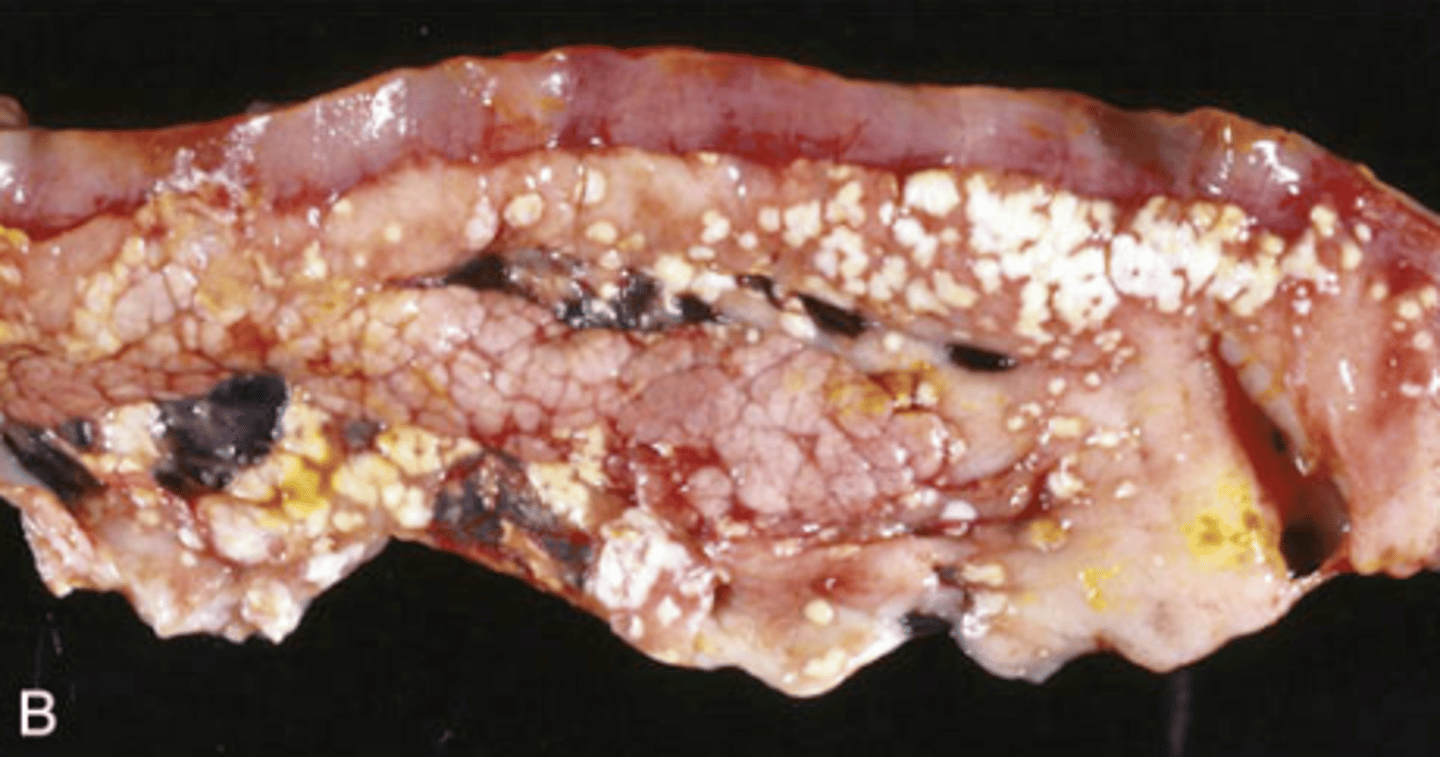 <p>This is an image of Fat Necrosis. What type of Fat Necrosis is seen? What causes this kind of fat necrosis?</p>
