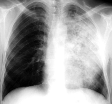 <p>dense well-defined consolidations usually apical<br><br>(image shows consolidation in upper and lower lobes)</p>