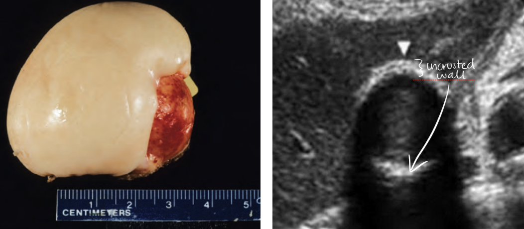 <p><mark data-color="yellow" style="background-color: yellow; color: inherit;">porcelain gallbladder</mark></p>