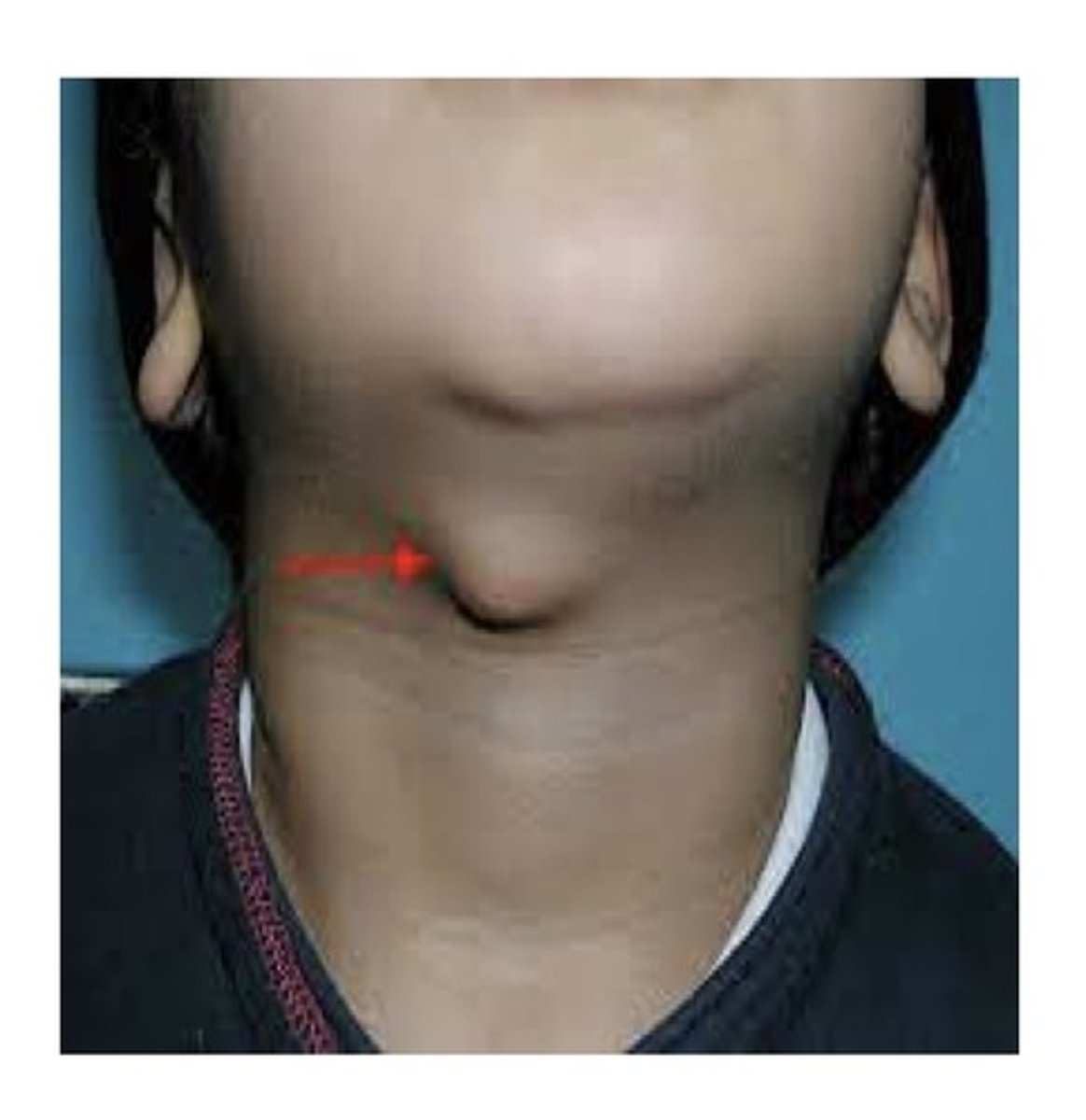 <p>Cyst that forms along the tract the thyroid gland follows in development. Found in young individuals (&lt;20 yrs of age). No sex predilection. Tx: excision of the cyst and tract.</p>