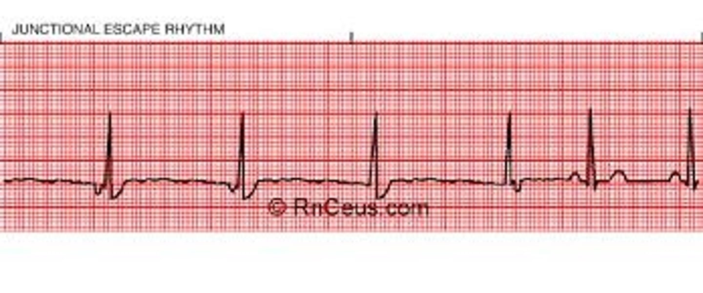 <p>1. P-P and R-R intervals are regular and similar; P-P interval may be difficult to determine due to location of P wave 2. Ventricular and Atrial rate: 40-60 bpm 3. P wave: usually inverted and may follow, precede, or be hidden by QRS complex 4. PR interval: before the QRS: less than 0.12 second and constant 5. QRS complex: WNL</p>