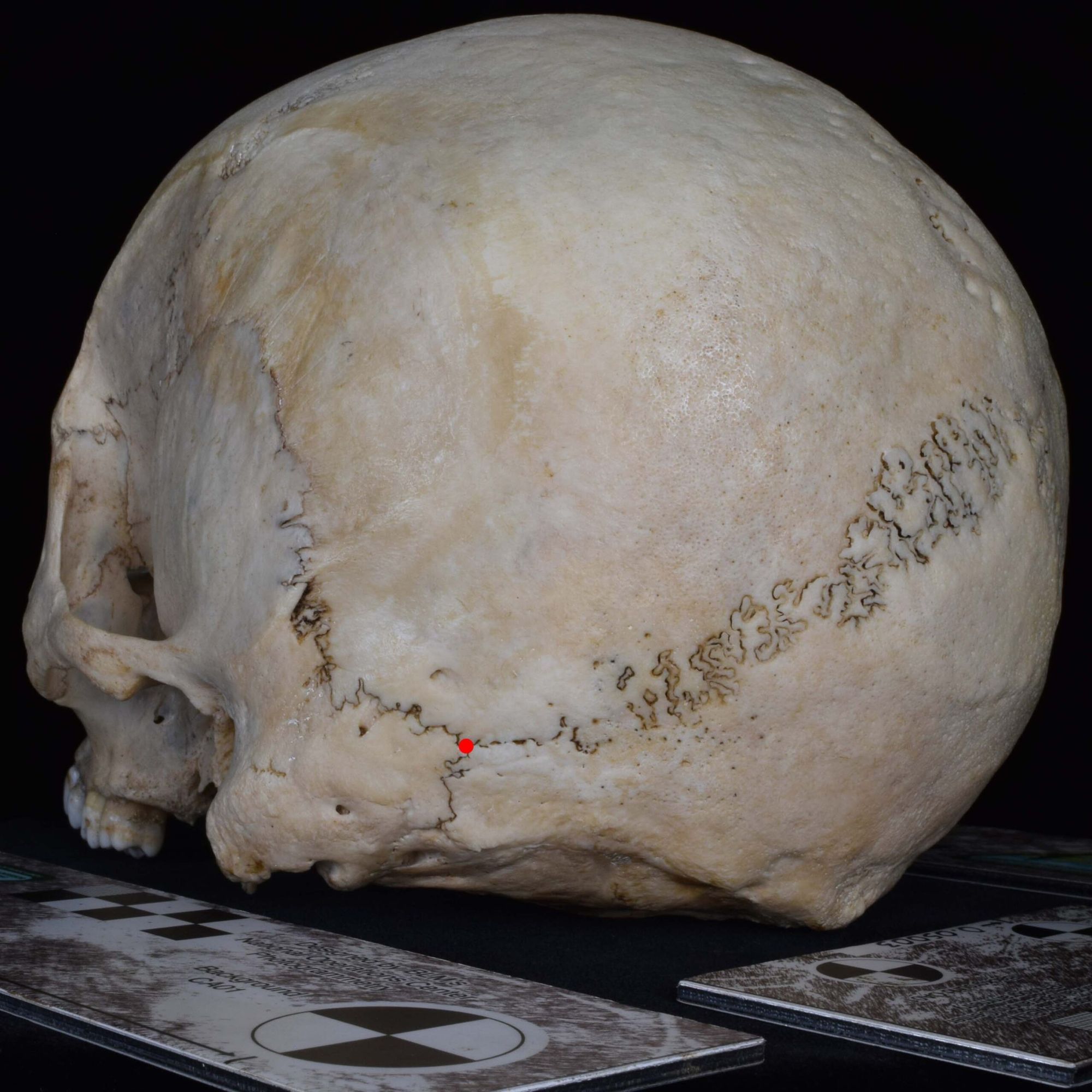 <p>Point where lambdoid, parietomastoid, and occipitomastoid sutures meet</p>