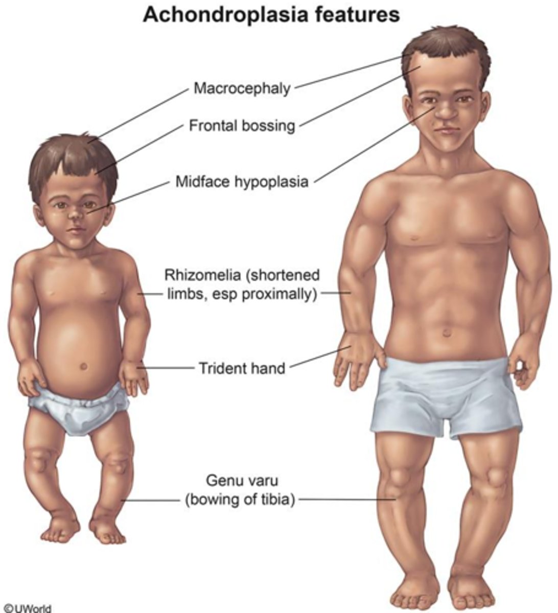 <p>Heterozygous Achondroplasia, characterized by mesomelia, trident hand, and large head with frontal bossing.</p>