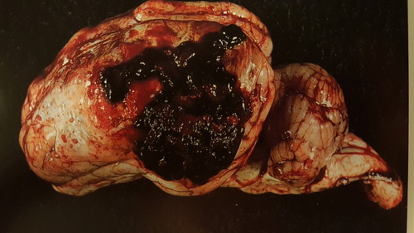 <p>Hjerne fra svin. Patoanatomisk diagnose? Hvordan kan det opstå?</p>