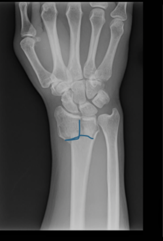 <p>A very common fracture that is often due to a FOOSH injury in the elderly</p>