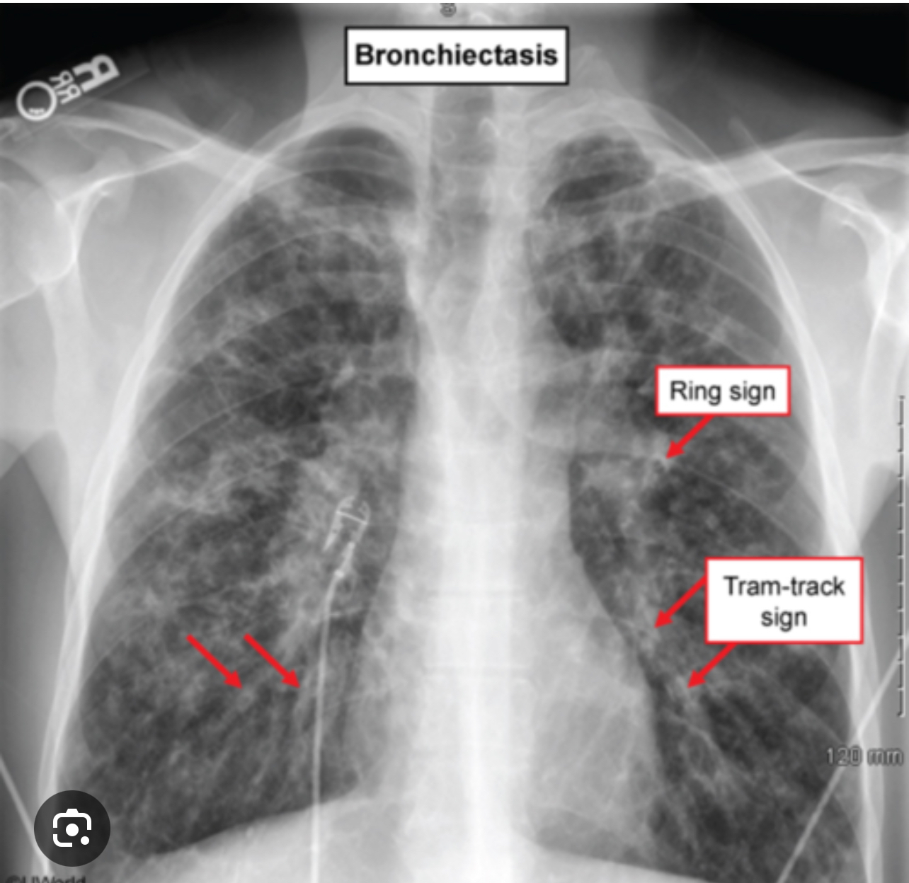 <ol><li><p>Chronic Persistent Cough +</p></li><li><p>Copious Excessive Sputum +</p></li><li><p>Recurrent respiratory tract infection +-</p></li><li><p>Others: weight loss, clubbing, dullness, crackles</p></li></ol><p></p><p>Other features: chest xray:</p><ol><li><p><strong>tramlines(tram track)“cyst/ring opacities”</strong></p></li></ol><ol start="2"><li><p>thick rings</p></li><li><p>Hemoptysis 1/3 pt</p></li></ol>