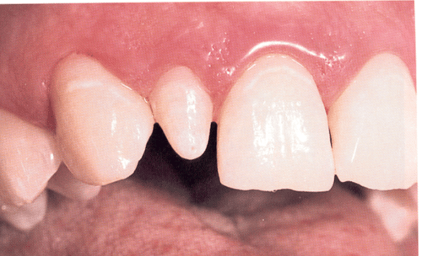 <p>peg-shaped lateral incisors</p>