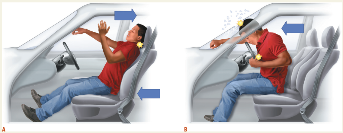 <p>Typically cause whiplash, with the head jerking backward and forward, leading to neck, head, and chest injuries. </p><p></p>