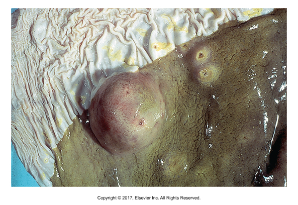 <p>Horse stomach worm</p><ul><li><p>Found: Worldwide​</p></li><li><p>Passed by flies (Muscidae family) which is intermediate host​</p></li><li><p>Symptoms: Gastritis, diarrhea, nodules in stomach​; can also cause skin involvement "summer sores"​</p></li><li><p>Elongated, thin shelled, larvated eggs found in fecals​</p></li><li><p>Eggs or larvae ingested by flies​</p></li><li><p>Cause of infection: Horse accidentally ingests fly with infective larvae inside​</p></li><li><p>Fly control and pasture rotation can limit infections</p></li></ul><p></p>