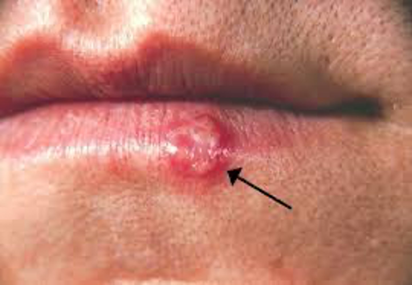<p>A patient present with a lesion that begins as vesicles and then ruptures into ulcers on the lower vermillion border. What is the most likely diagnosis?</p>