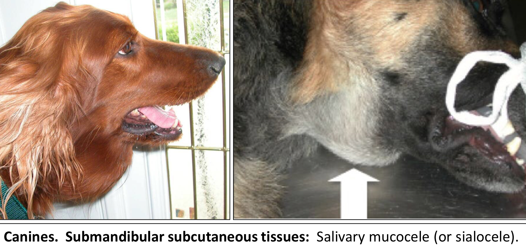 <ul><li><p>A pseudocyst of the Salivary Gland</p></li><li><p>It occurs as the result of <u>accumulation in the submucosa or subcutaneous tissue</u> after damage to the salivary duct</p><ul><li><p>It is a pocket of saliva in the submandibular soft tissue</p></li></ul></li></ul><p></p>