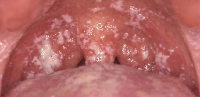 <p>pt presents with metallic taste and burning sensation, white plaque that can be wiped off </p>