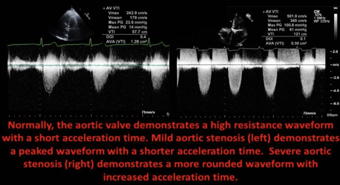 <p>Spectral Doppler finding seen with AS</p>