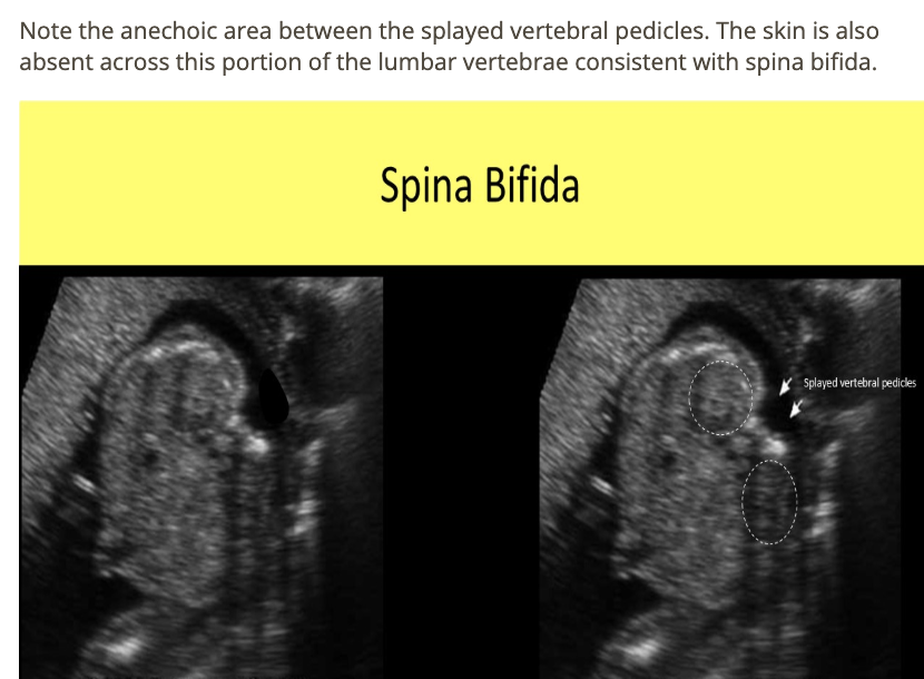 <p>d) there are 2 normal kidneys seen but spina bifida too </p>