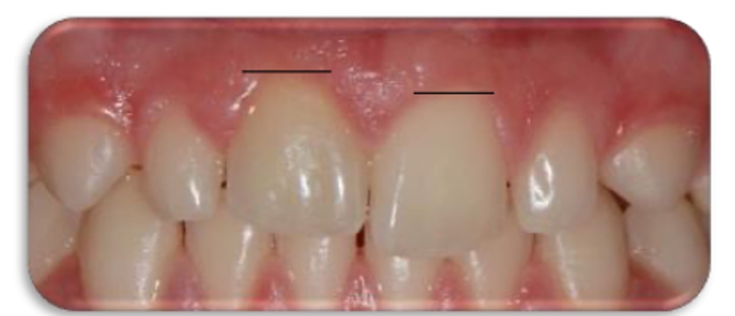 <p>Patient presents with a metallic sound on percussion, infraoccluded appearance in developing dentition and may not respond to sensibility testing. What is the most likely diagnosis? </p>