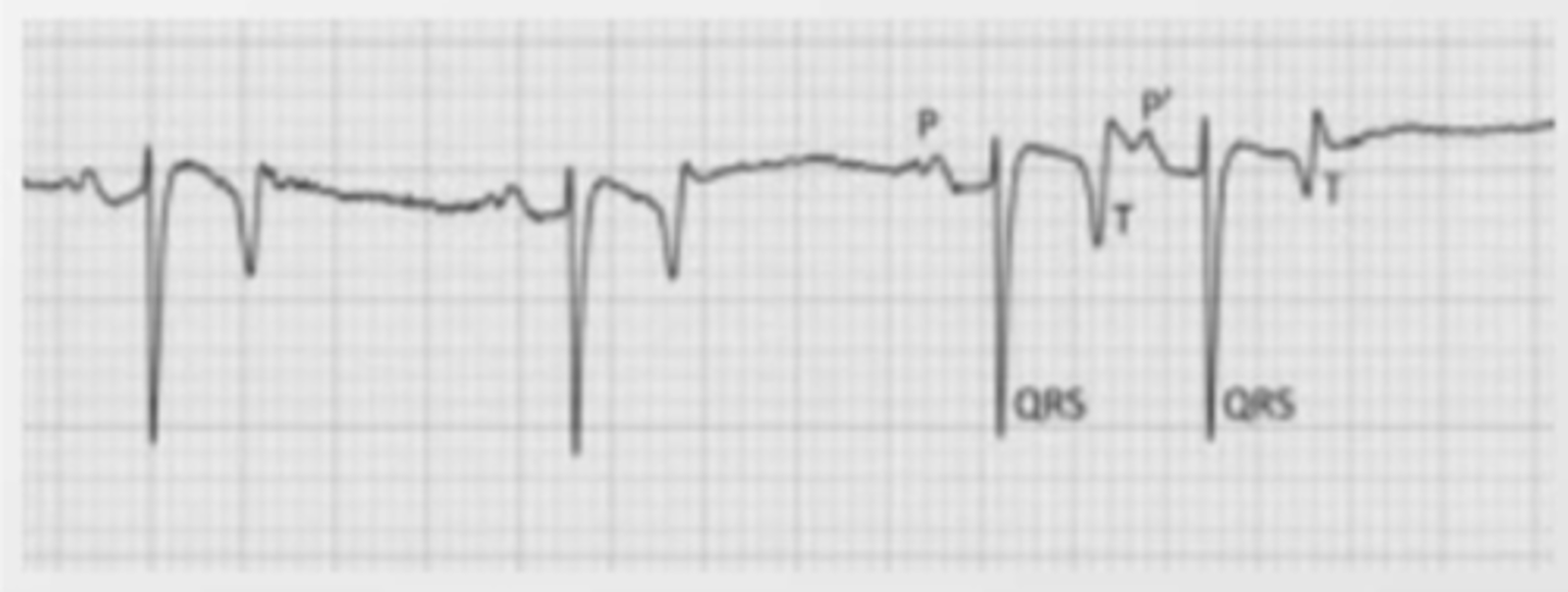 <p>what type of arrhythmia is this? (ignore the negative QRS)</p>