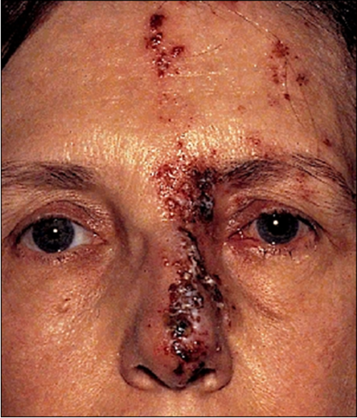 <ul><li><p>Varicella (<strong>chicken pox vius)</strong></p></li></ul><p></p><ul><li><p>herpesvirus-3</p></li></ul><p></p><ul><li><p>pain/neuralgia (<strong>tingling </strong>pain) - one sided</p></li></ul><p></p><ul><li><p><mark data-color="purple" style="background-color: purple; color: inherit;">vesicular rash</mark></p></li></ul><p></p><ul><li><p><mark data-color="purple" style="background-color: purple; color: inherit;">lesion tip on nose</mark> (hutchingsons sign)- higher risk of ocular complications</p></li></ul><p></p><ul><li><p><mark data-color="purple" style="background-color: purple; color: inherit;">oral acyclovir within 72 hours</mark> of vesicles starting ,reduces eye disorders from 50% to 20-30% + reduces pain</p></li></ul><p></p>