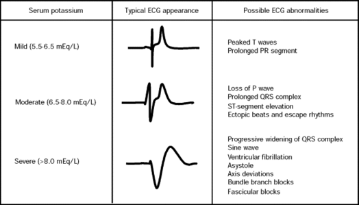 <p><strong>SEVERE hyperkalemia ECG</strong></p>