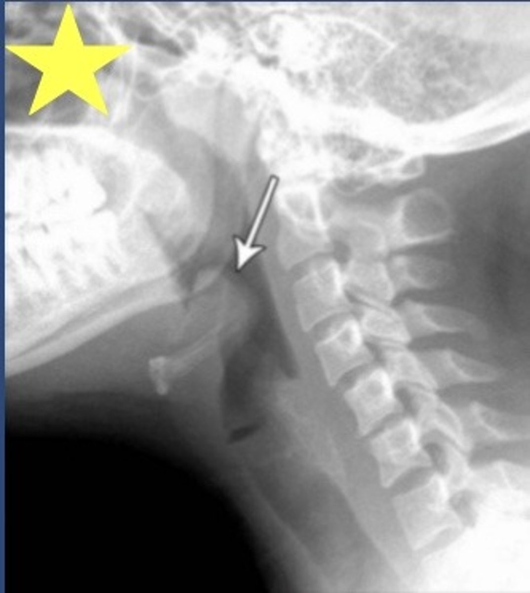 <p>Identify the radiographic abnormality.</p>