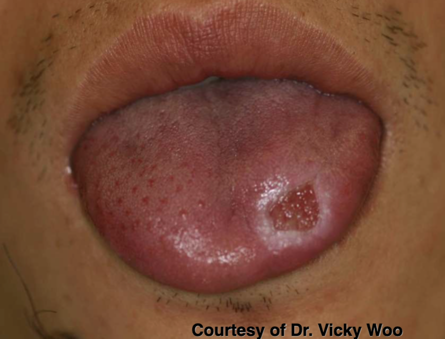<ol><li><p>commonly on tongue </p></li><li><p>often surrounded by white hyperkeratotic rim</p></li></ol><p></p>