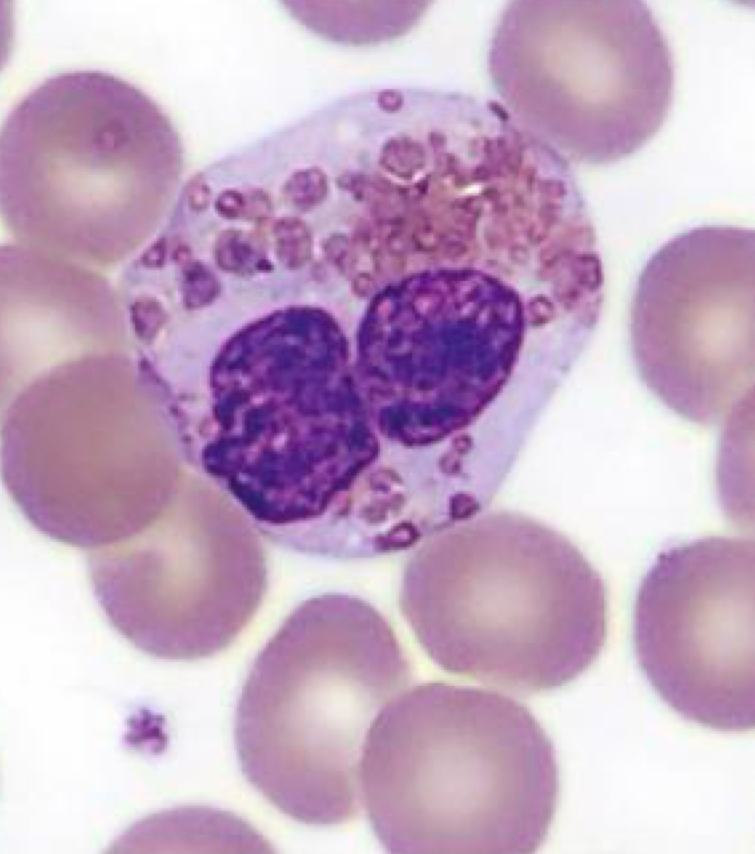 <p>Eosinophil, Chediak Higashi Syndrome</p>