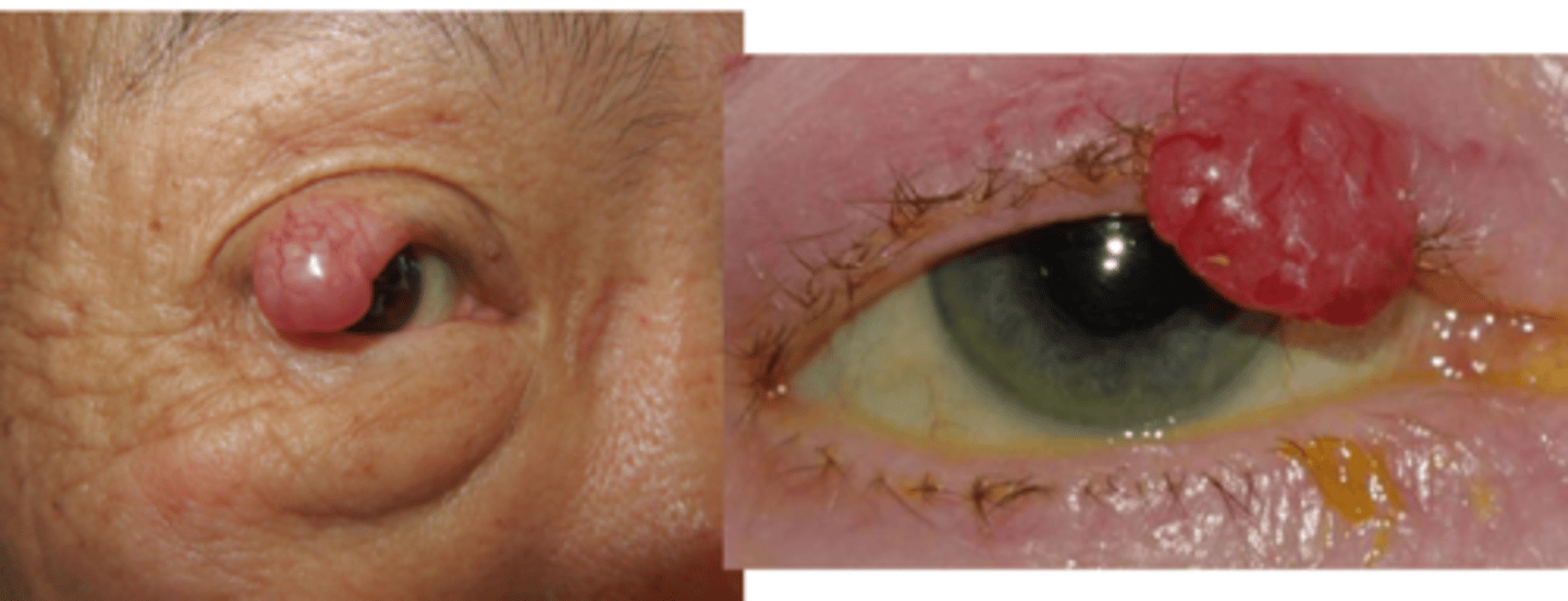 <p>painless nodule on UL with violaceous hue, some ulceration</p><p>+/- madarosis</p><p>surrounding skin is hard, smooth</p>