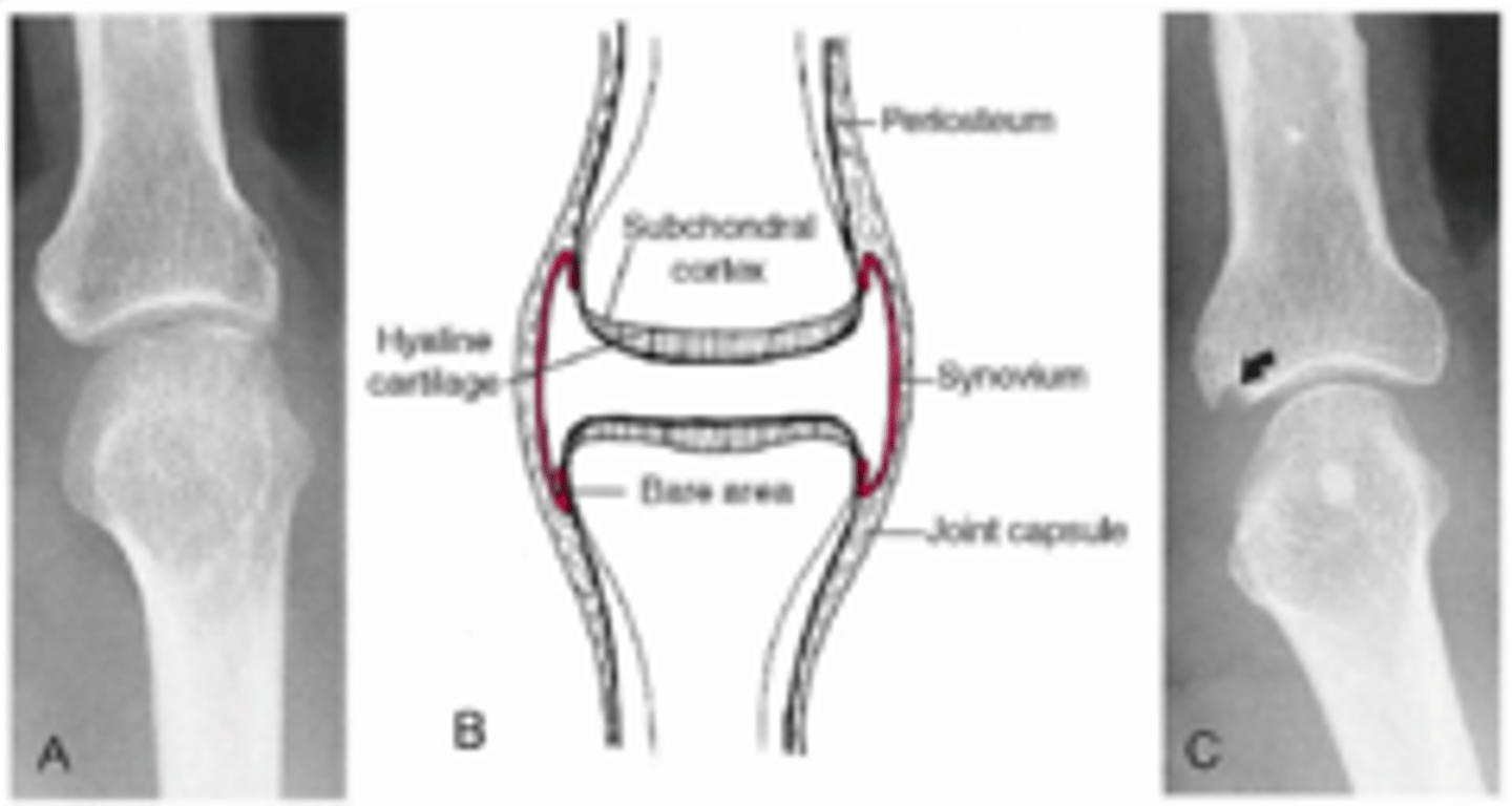 <p>Erosive changes from _____ formation affecting the _____</p>