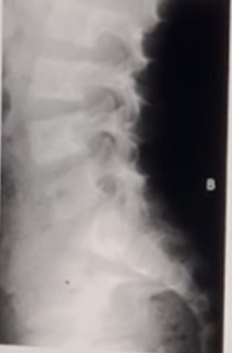 <p>The patient above demonstrates dilation of the thecal sac along with numerous nerve sheath tumors.</p><p>Which of the following conditions could also cause the vertebral body changes?</p><p>Choose all that apply.</p><p>Acromegaly</p><p>Marfan syndrome</p><p>Achondroplasia</p><p>Spinal tumor</p>