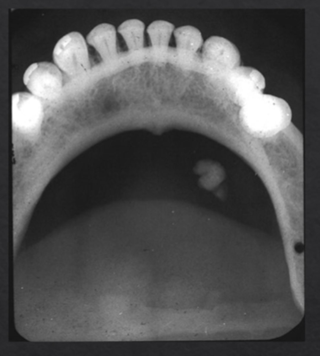 <p>Salivary Stones: calcified stones within salivary ducts</p>
