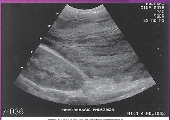 <p>A _______ pancreatitis is an _______ process that spreads along _____ pathways, causing localized areas of diffuse inflammatory _____ of soft tissue that may proceed to necrosis and suppuration </p>