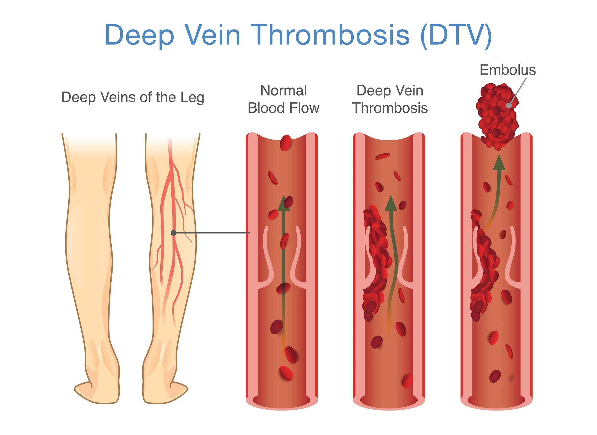 <p>Deep Vein Thrombosis.</p>