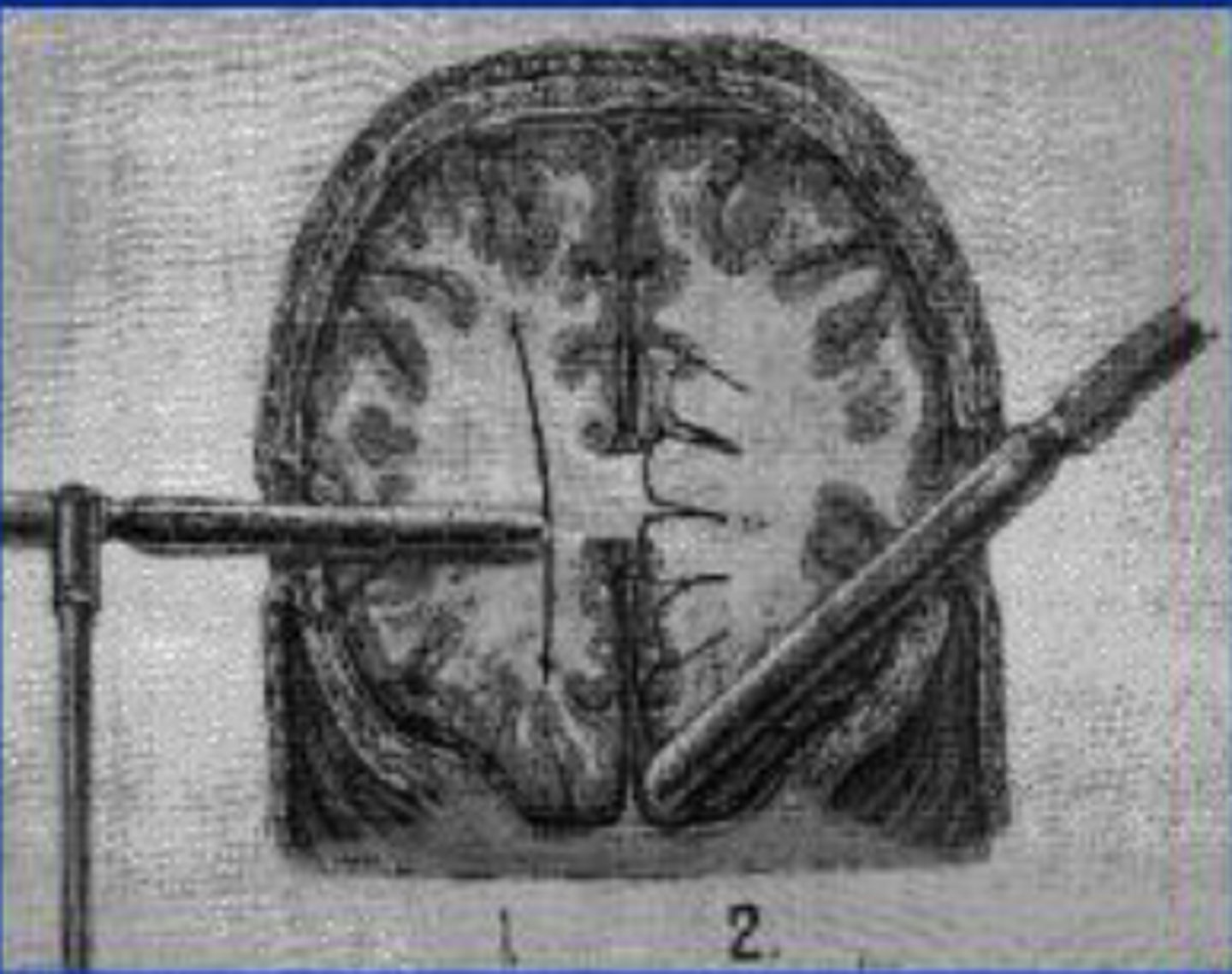<p>surgical procedures on brain tissue that remove or disconnect nerve pathways to treat mental disorders</p>