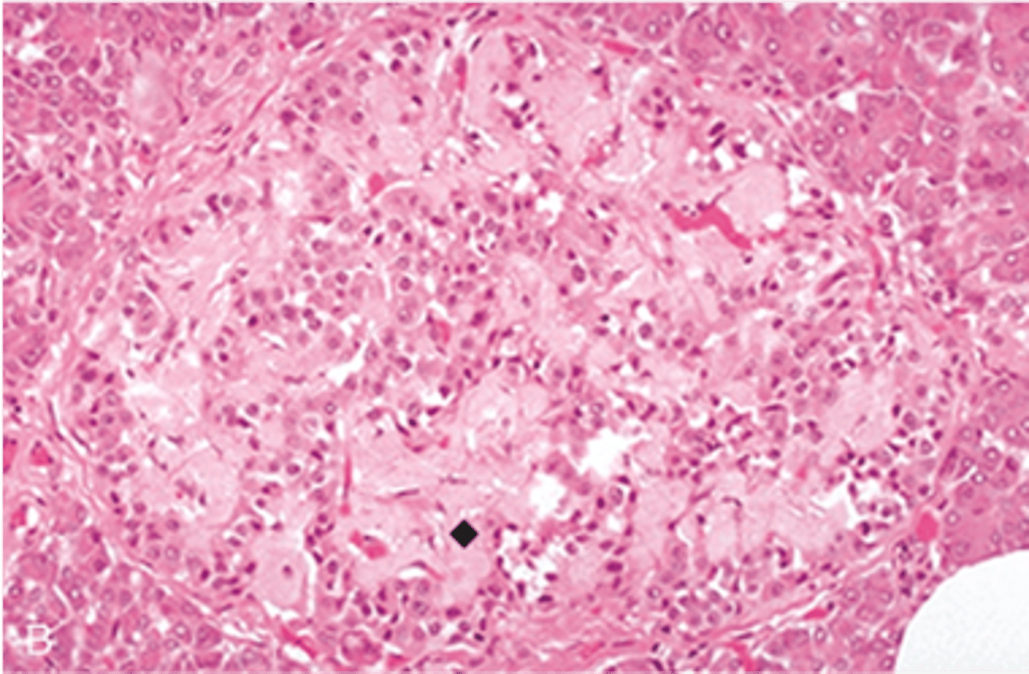 <p>Define Condition:</p><p>End-organ INSULIN RESISTANCE leading to Associated Beta-cell dysfunction leading to Metabolic disease involving inappropriately increasing blood glucose - Issue with INSULIN RECEPTOR</p><p>-Hx:</p><p>&gt; MC Type (90%)</p><p>&gt; A/w...</p><p>&gt;&gt; OBESITY</p><p>&gt;&gt; GENETIC PREDISPOSITION</p><p>&gt; Onset = Adulthood (but more incidence in childhood/teens)</p><p>-Path:</p><p>&gt; Insulin made, but skeletal muscle/fat and liver don't respond --&gt; Hyperglycemia</p><p>&gt; Central Obesity (Abd/Visceral Fat) = More LIPOLYTIC (more adipokines &amp; FFAs --&gt; inflammation --&gt; INSULIN RESISTANCE &amp; BETA CELL DYSFUNCTION)</p><p>-Dx:</p><p>Labs = INSULIN starts high, then drops with advanced disease</p><p>Histo</p><p>&gt; Beta-cell hyperplasia &amp; hypertrophy (overcompensation by insulin resistance) --&gt; Less Beta cells --&gt; Less Insulin ==&gt; Hyperglycemia</p><p>&gt; Amyloid in islets = Beta-cells also secrete amyloid polypeptide (amylin) --&gt; More insulin = More Amylin accumulation</p>