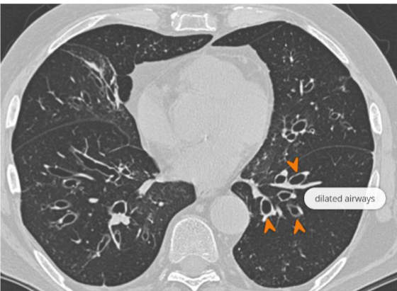 <ul><li><p><span>High Resolution CT – gold standard → Signet ring sign: bronchus > accompanying pulmonary artery</span></p></li><li><p><span>Sputum culture</span></p></li><li><p><span>Chest x-ray: </span></p></li><li><p><span>Oxygen saturation levels</span></p></li><li><p><span>Full blood count incl. WCC, CRP</span></p></li><li><p><span>Spirometry – identify severity of airflow obstruction</span></p></li></ul><p></p>