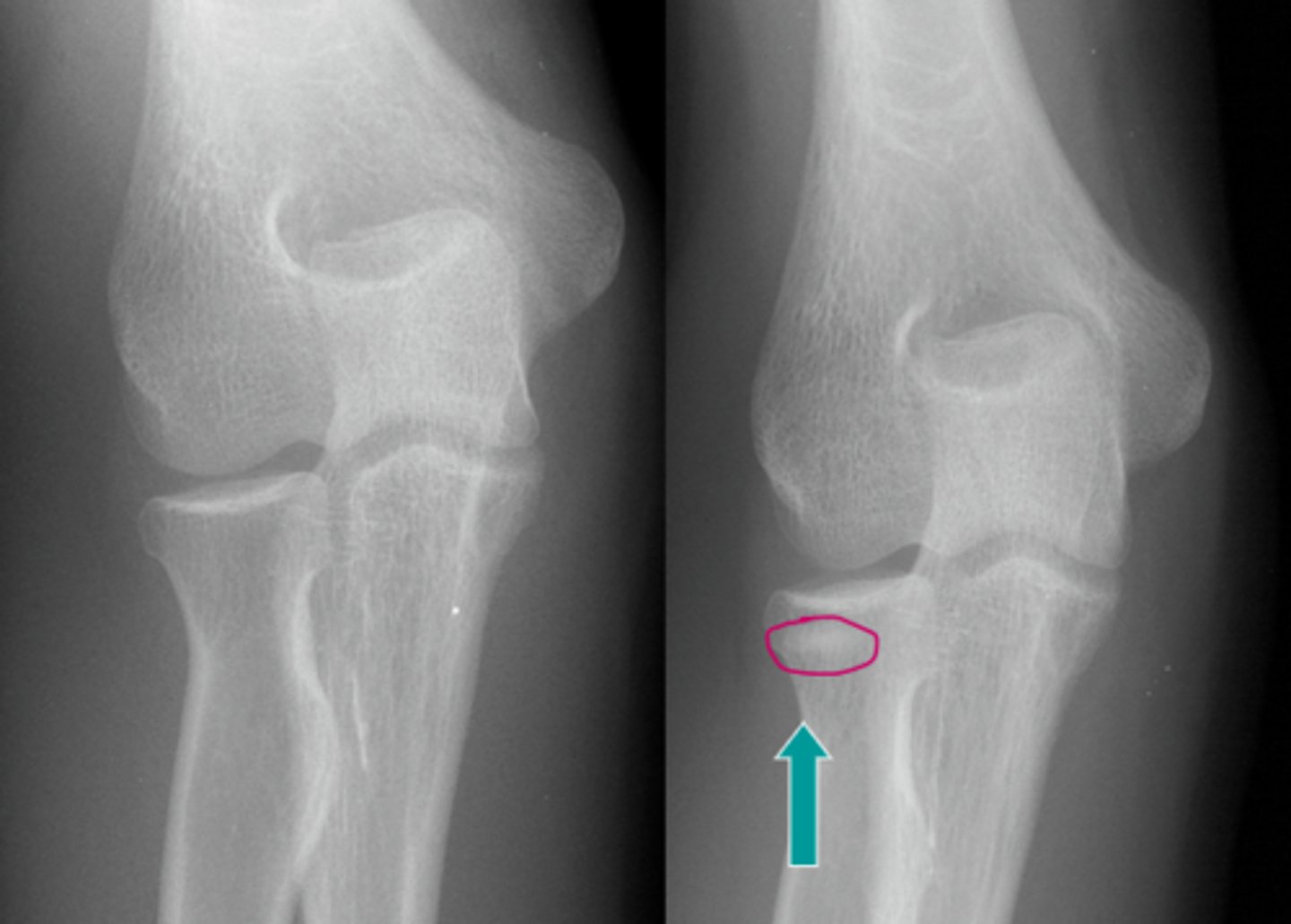 <p>Anterior sails sign with no posterior fat pad sign. Most likely radial head fx given its an adult.</p>