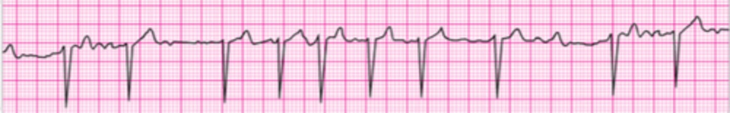 <p>A patient presents with the rhythm below and reports an irregular heartbeat. She has no other symptoms. Her medical history is significant for a myocardial infarction 7 years ago. Blood pressure is 110/70 mm Hg. What would you do at this time?</p><p>1. Perform elective synchronized cardioversion with presedation.</p><p>2. Continue monitoring and seek expert consultation.</p><p>3. Administer nitroglycerin 0.4 sublingual or spray.</p><p>4. Administer lidocaine 1mg/kg IV.</p><p>5. Perform emergency synchronized cardioversion</p>