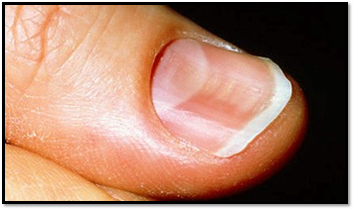 <p>anemia/trauma</p>