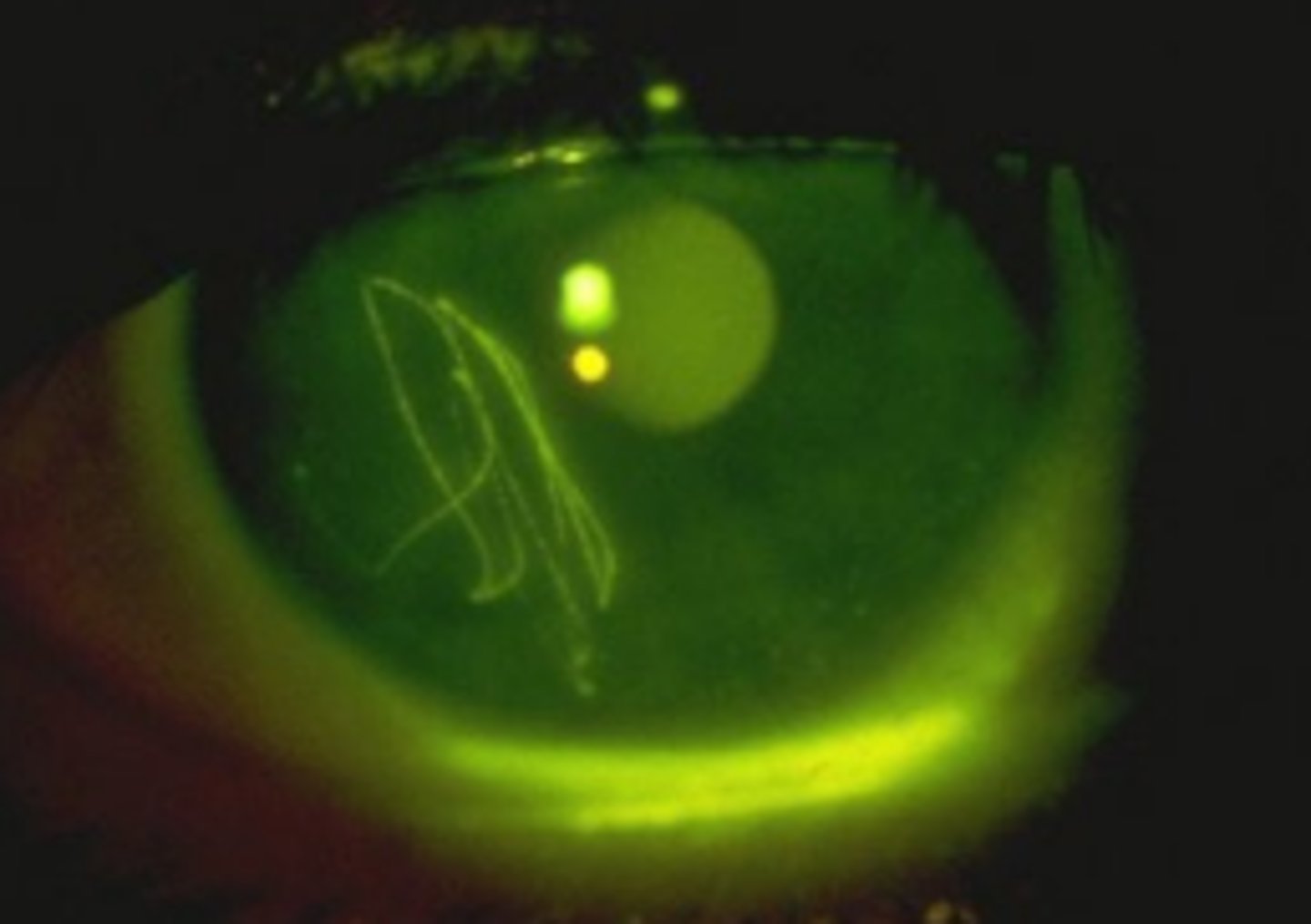 <p>one of the most common ophthalmic injuries involving partial or complete removal of the corneal epithelium. If Bowman's layer is intact, no scarring will occur. Pain occurs that is typically out of proportion to the injury size. Variable VA depending on the location of the defect and the presence of edema. Do not use bandage CL in contact lens wearers</p>